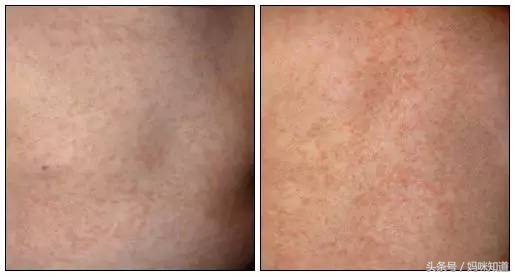 春暖花开要预防过敏性皮肤疾病,春暖花开一定要小心四种虫