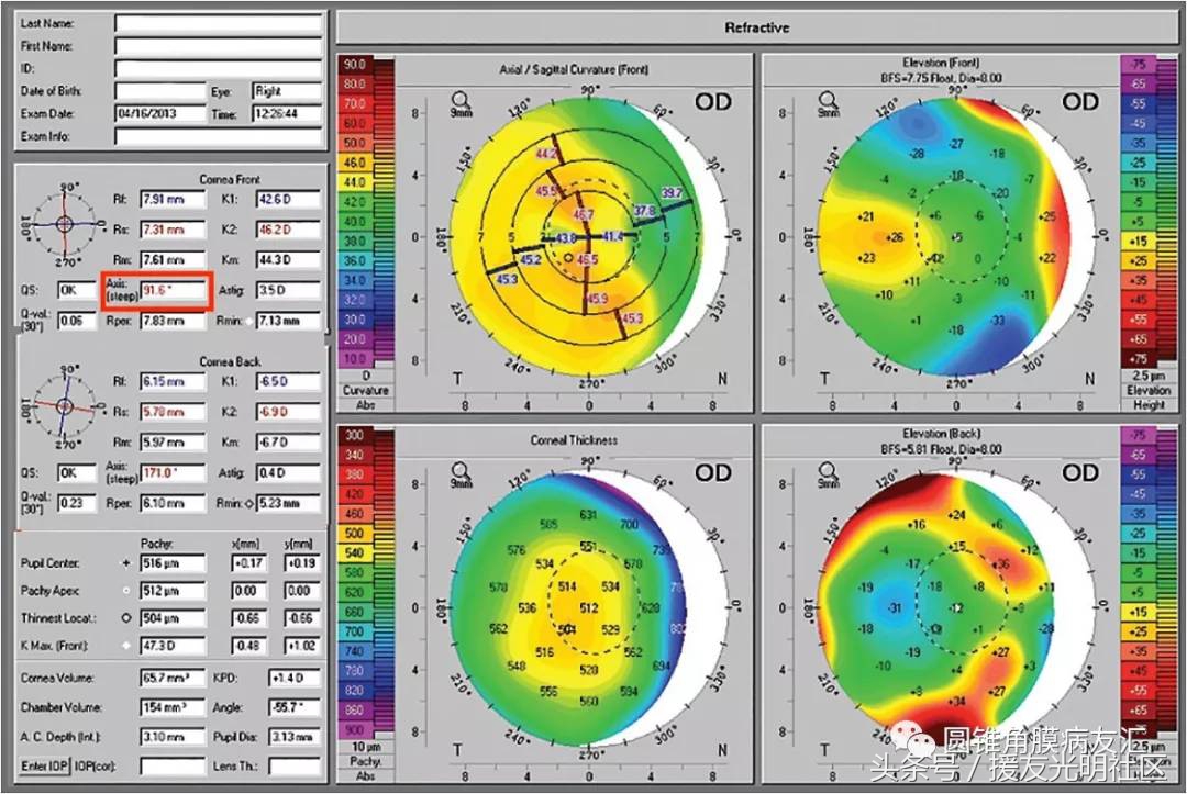 角膜地形图诊断标准,角膜地形图能确诊圆锥角膜
