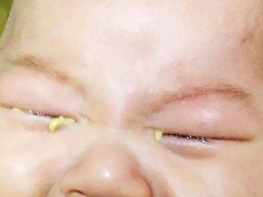 宝宝眼屎多警惕新生儿泪囊炎,儿科医生宝宝眼睛有眼屎