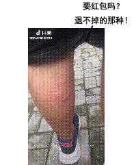 登革热夺走20多条生命,登革热是典型的儿童疾病吗