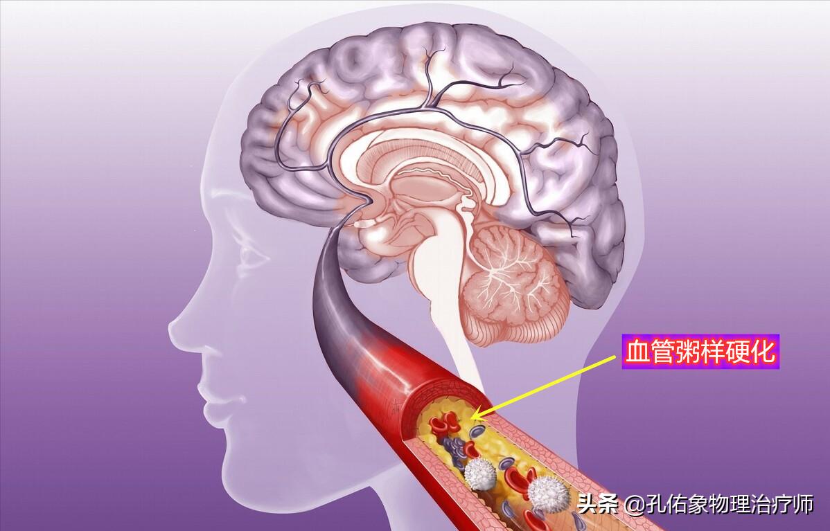 老年人高血脂的危害,老年人血脂高危害大吗