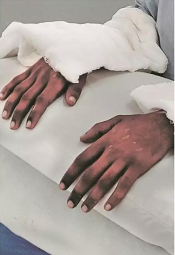 印度少女移植男性黝黑双手，肤色神奇变白，嫩滑无毛如纤纤玉手