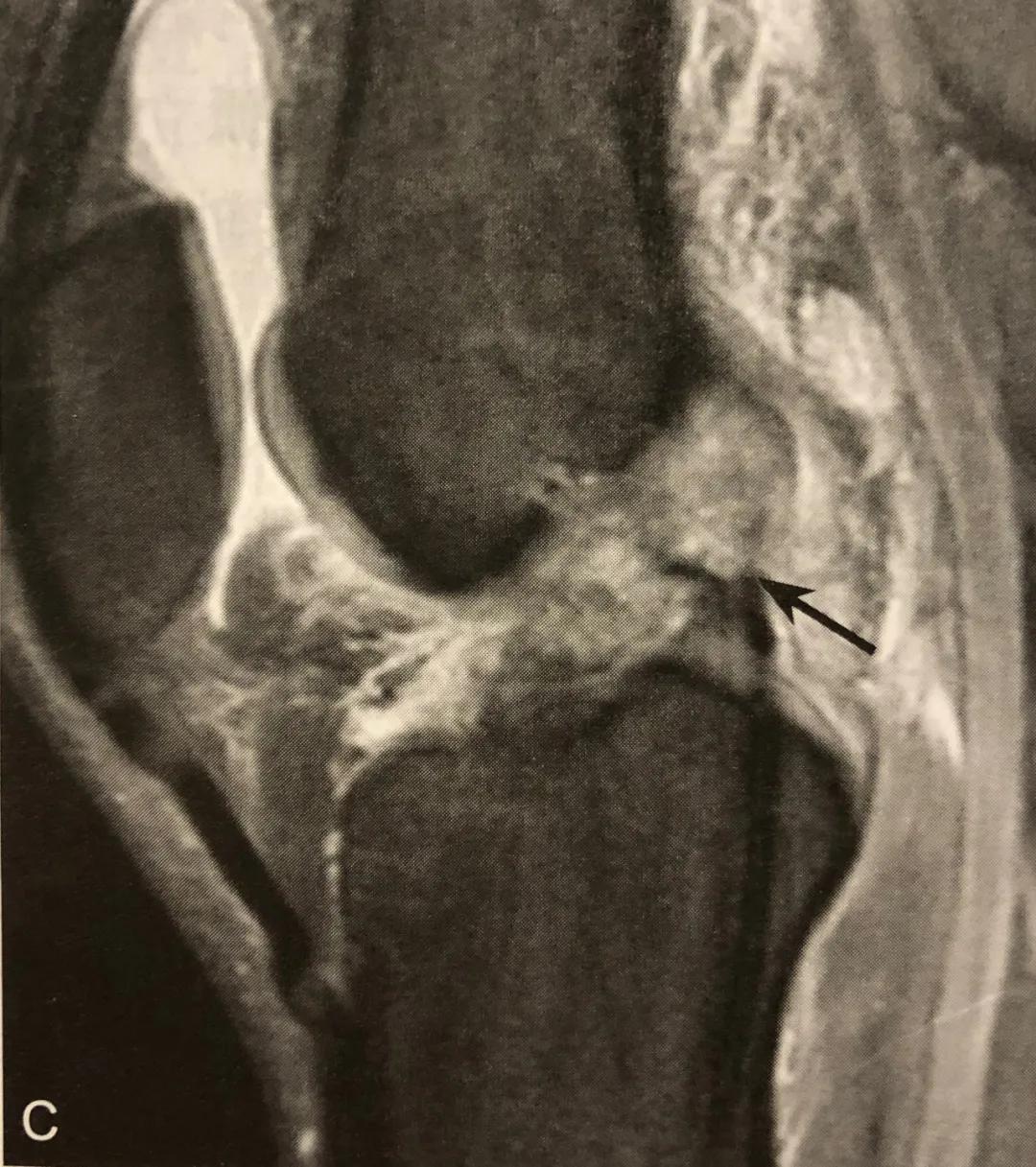 膝关节常见损伤的检查方法,膝关节损伤病例图片