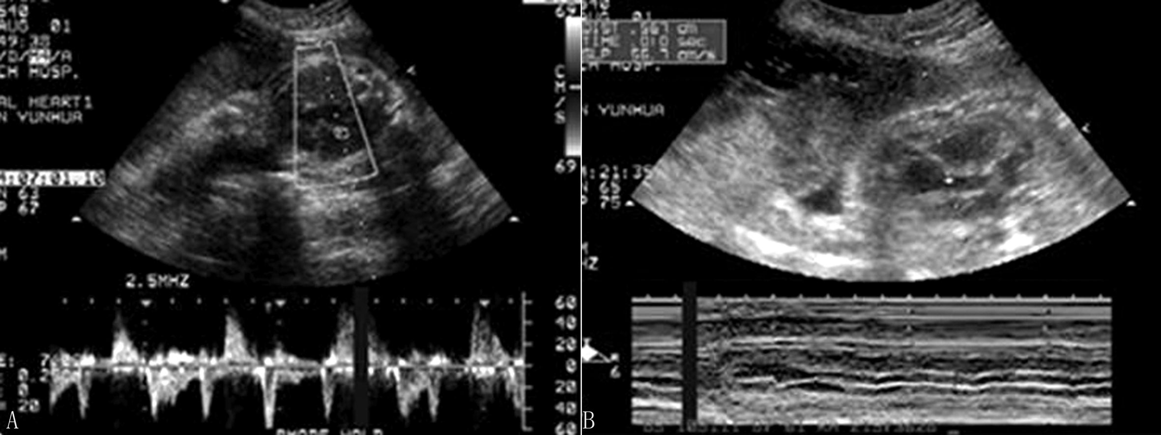 胎儿超声结果显示心跳过速,27周胎儿心律不齐早搏