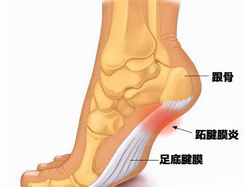 跟骨骨折和足跟骨刺哪个严重,足跟骨刺走路疼痛该如何治疗