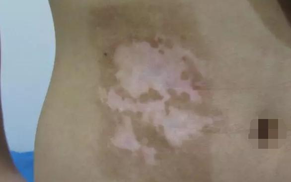白癜风黑色素再生疗法,白癜风的黑色素缺失怎么造成的
