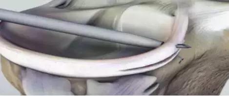 强生半月板缝合器多少价格,强生半月板缝合器