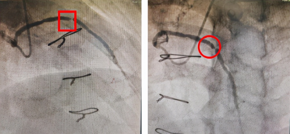 哈医大二院完成静脉桥血管再狭窄OCT指导下药物球囊介入治疗