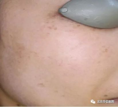 光子嫩肤唤醒肌肤活力重塑娇颜,光子嫩肤让你焕颜一新