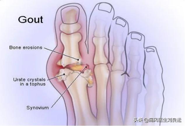 脚很痛不知道是扭伤还是痛风,脚痛不肿怎么判断是不是痛风