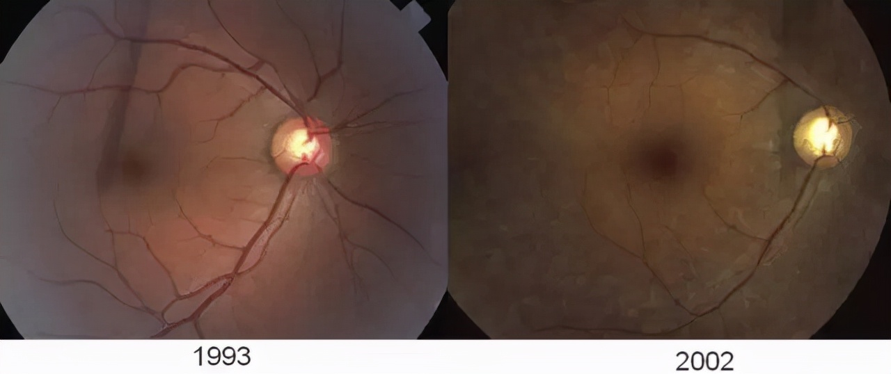 羟氯喹治疗风湿的替代药物,羟氯喹有抗疟疾作用吗