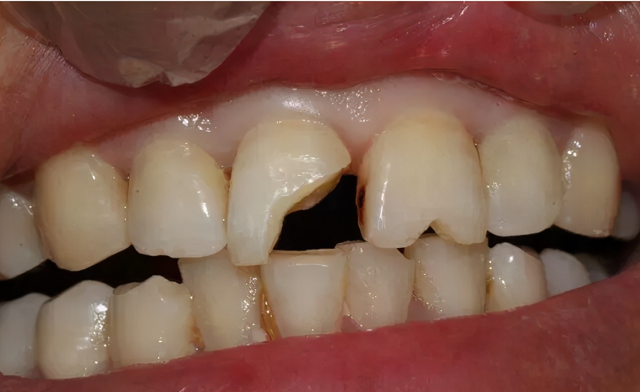 牙髓坏死还做根管治疗吗,牙髓坏死了需要取出来吗