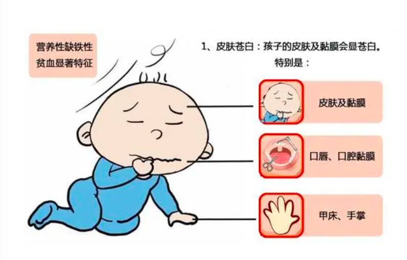 缺铁性贫血治疗指南最新,中国缺铁性贫血现状