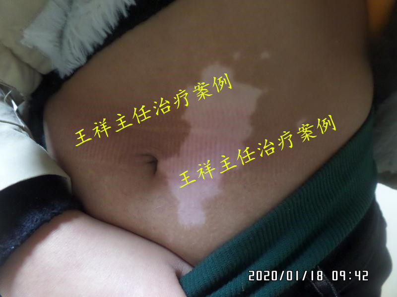 白癜风黑色素种植效果好吗,黑色素种植治疗白癜风费用