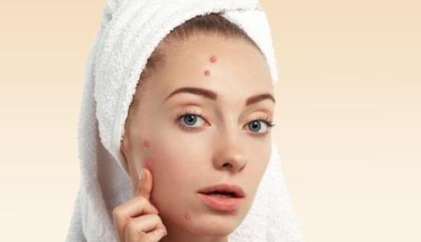 怎么样不长痘痘跟粉刺,如何不会长痘痘