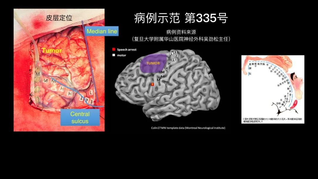 五个能控制你大脑的可怕实验,电击治疗精神分裂症会失忆吗