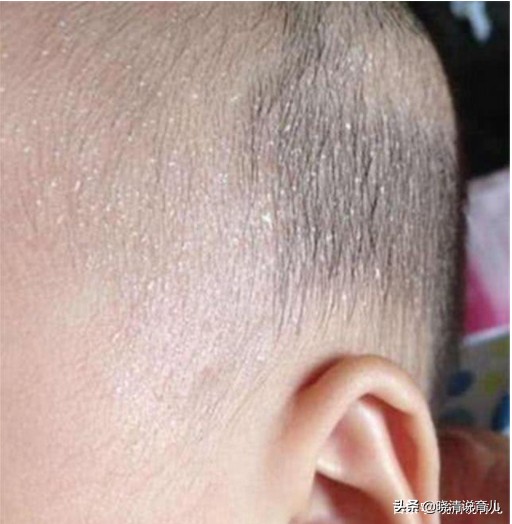2岁宝宝头部出汗多怎么回事,宝宝老是头出汗像水洗的一样