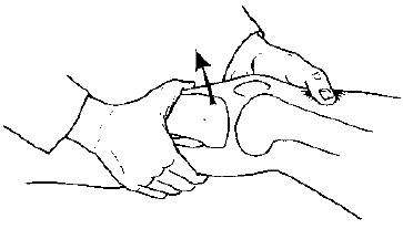 前叉术后绷直腿会导致韧带松弛吗,前叉韧带重建手术后怎么避免松弛