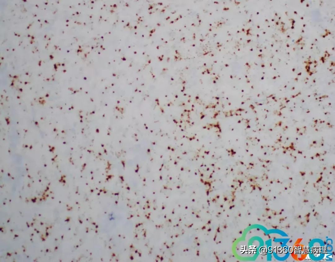 宫颈腺癌silvaa型严重吗,宫颈腺癌silvab型复发率高吗