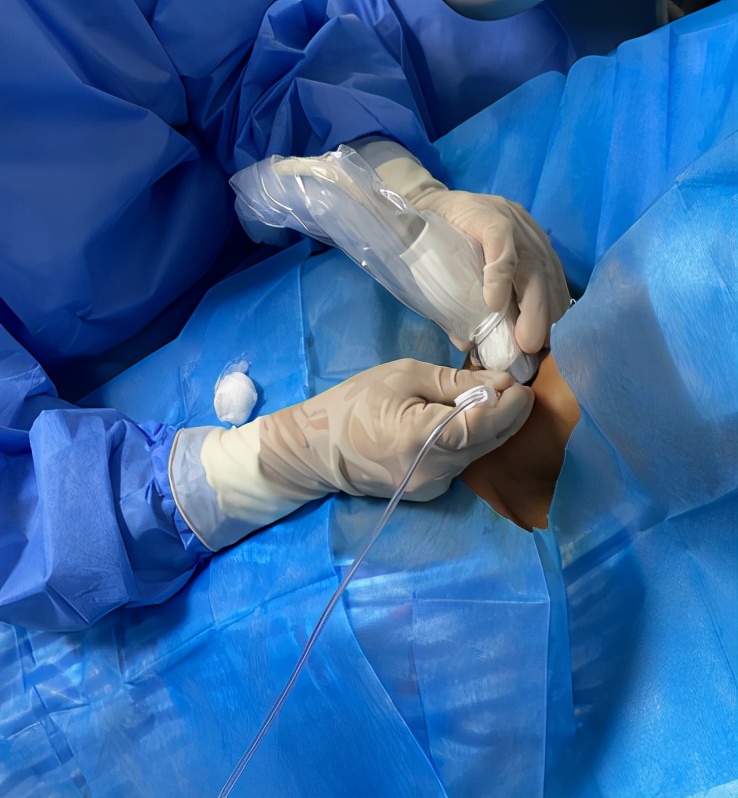 甲状腺结节微波消融术,厦门有微波消融术治疗甲状腺结节