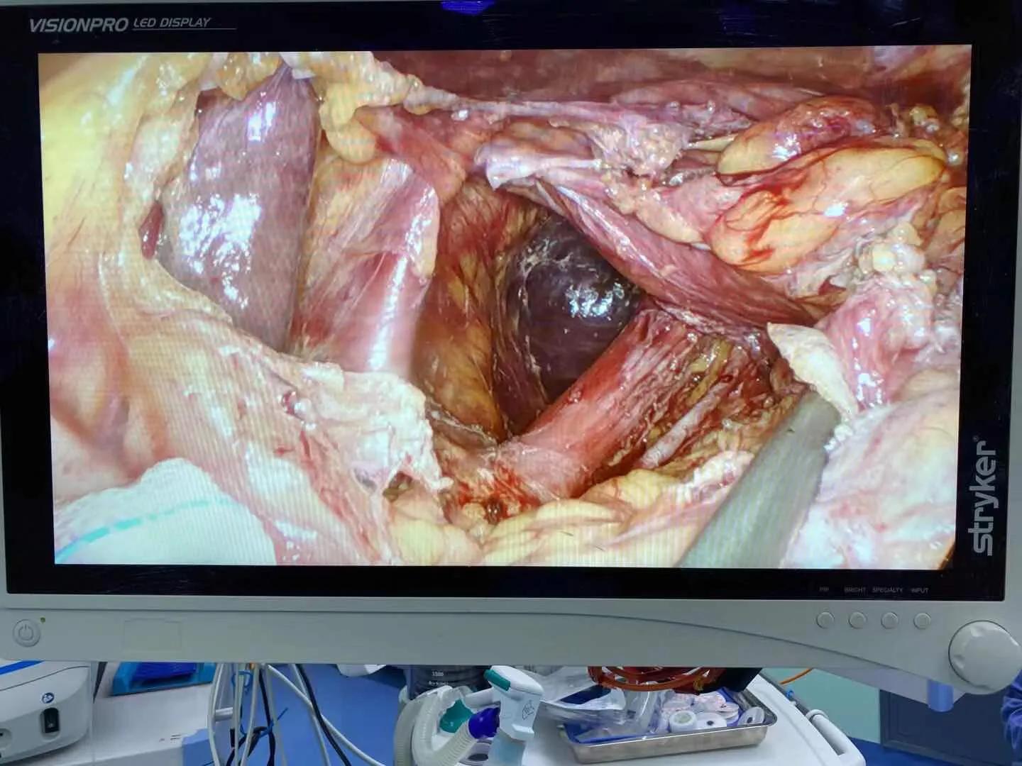 胃跑到胸腔了怎么办,胃跑到胸腔里做什么手术