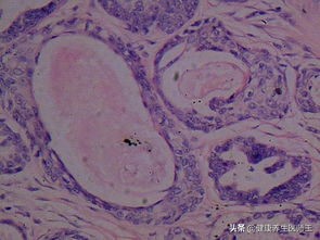 外阴良性肿瘤需要动手术吗,外阴良性肿瘤切除术