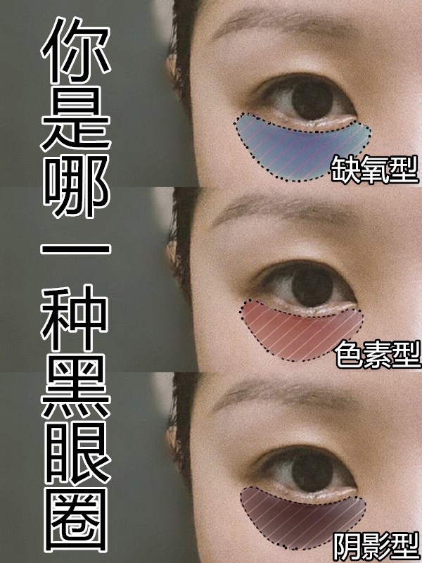 这7个方法迅速缓解你的黑眼圈,如何才是解决黑眼圈的最好方法