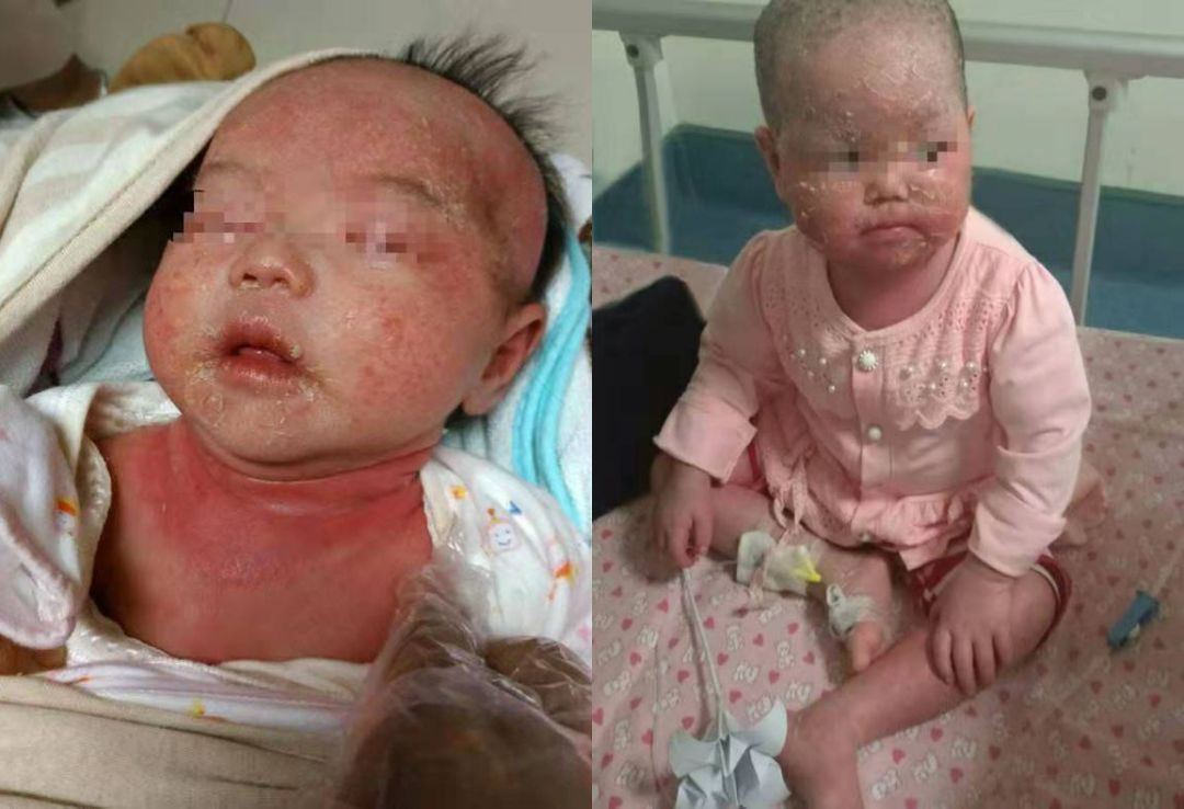 宝宝出生全身脱皮皮肤很红,出生半月的婴幼儿皮肤脱皮