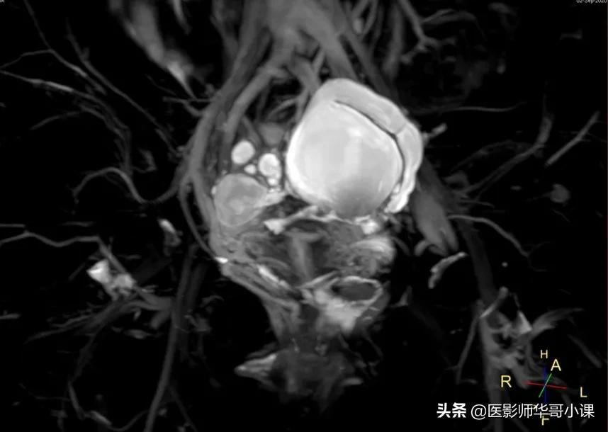 [飞利浦磁共振技术]磁共振扫描下的“女性输卵管成像”，看视频吧