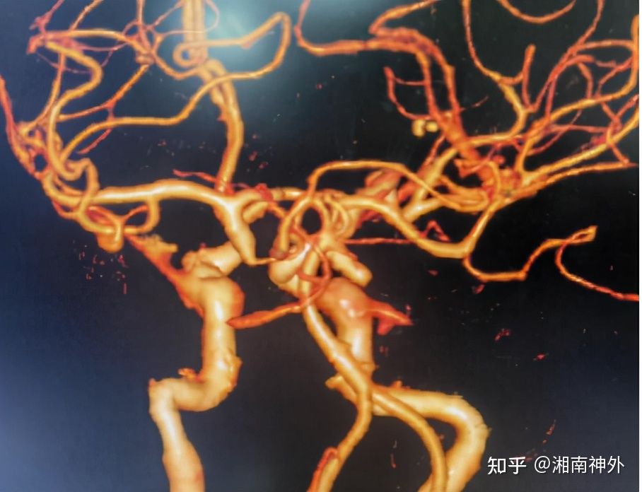 脑动脉瘤的定时炸弹,颅内定时炸弹