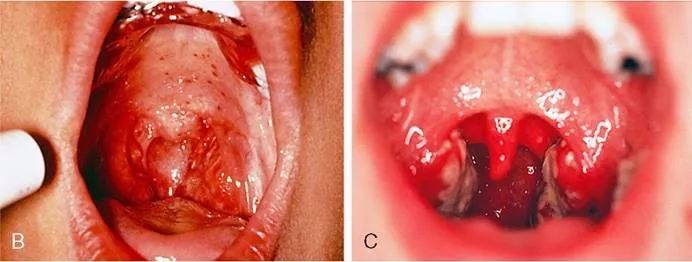 发热出红疹子可以吃过敏药吗,发热皮疹会反复么