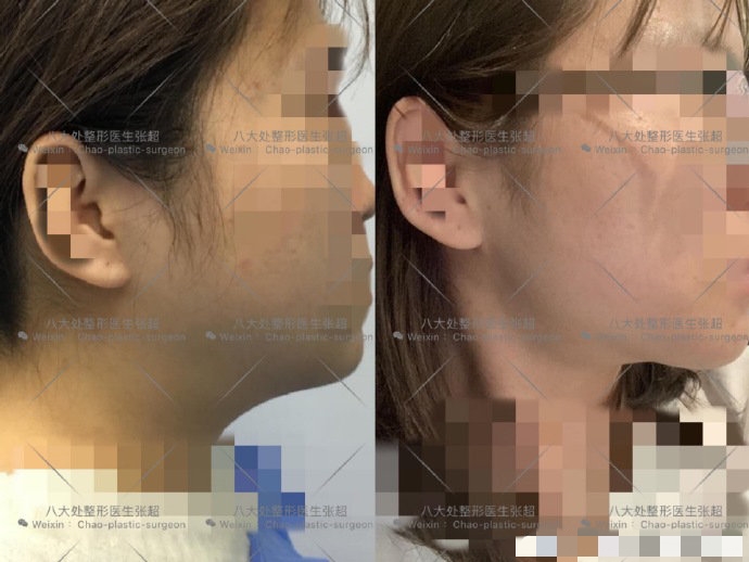 八大处整形张超,八大处张超最新视频