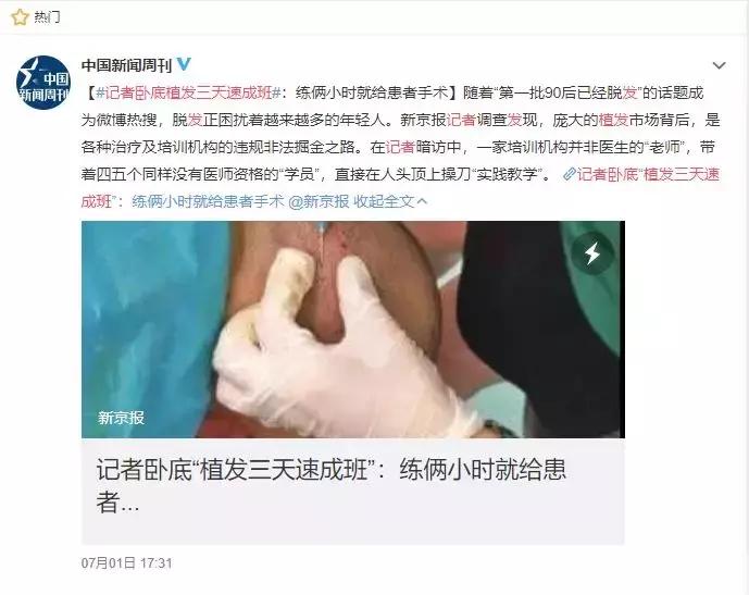 你的脱发到几级了,你的脱发还有得救吗