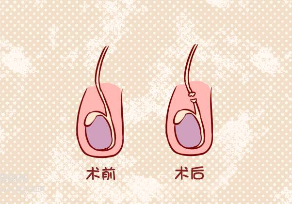 是什么原因导致男人结扎,男性结扎到底会不会影响什么