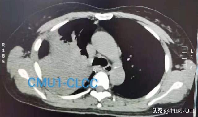 胸腔长了个小瘤子怎么办,胸腔长瘤该怎么办