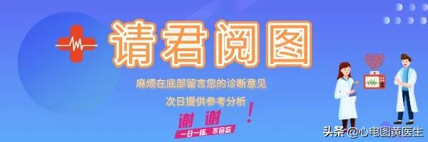 心电图一二三代表什么,心电图一二三导联示意图