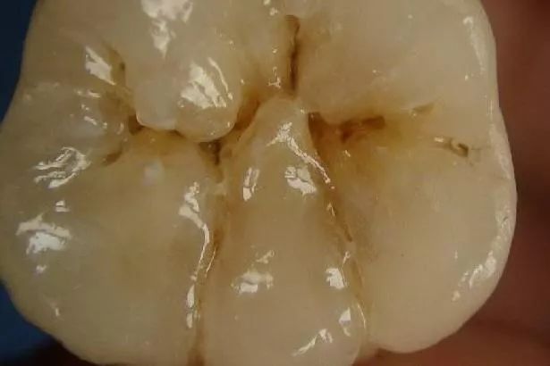 孩子蛀牙要戴牙冠吗,孩子蛀牙也需要根管治疗吗