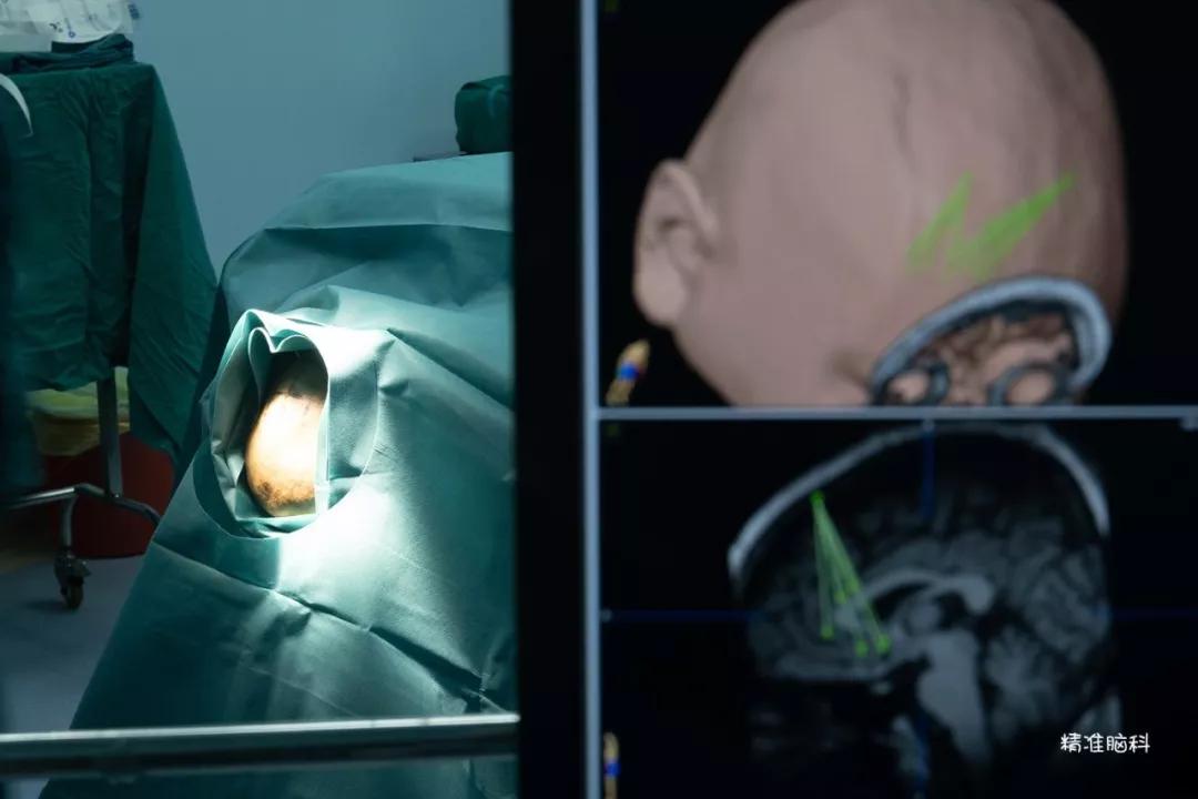 精神分裂症多长时间恢复正常上班,孩子得了精神分裂症怎么帮他恢复