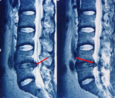 腰椎间盘突出你了解吗,腰椎间盘突出症的科普问答