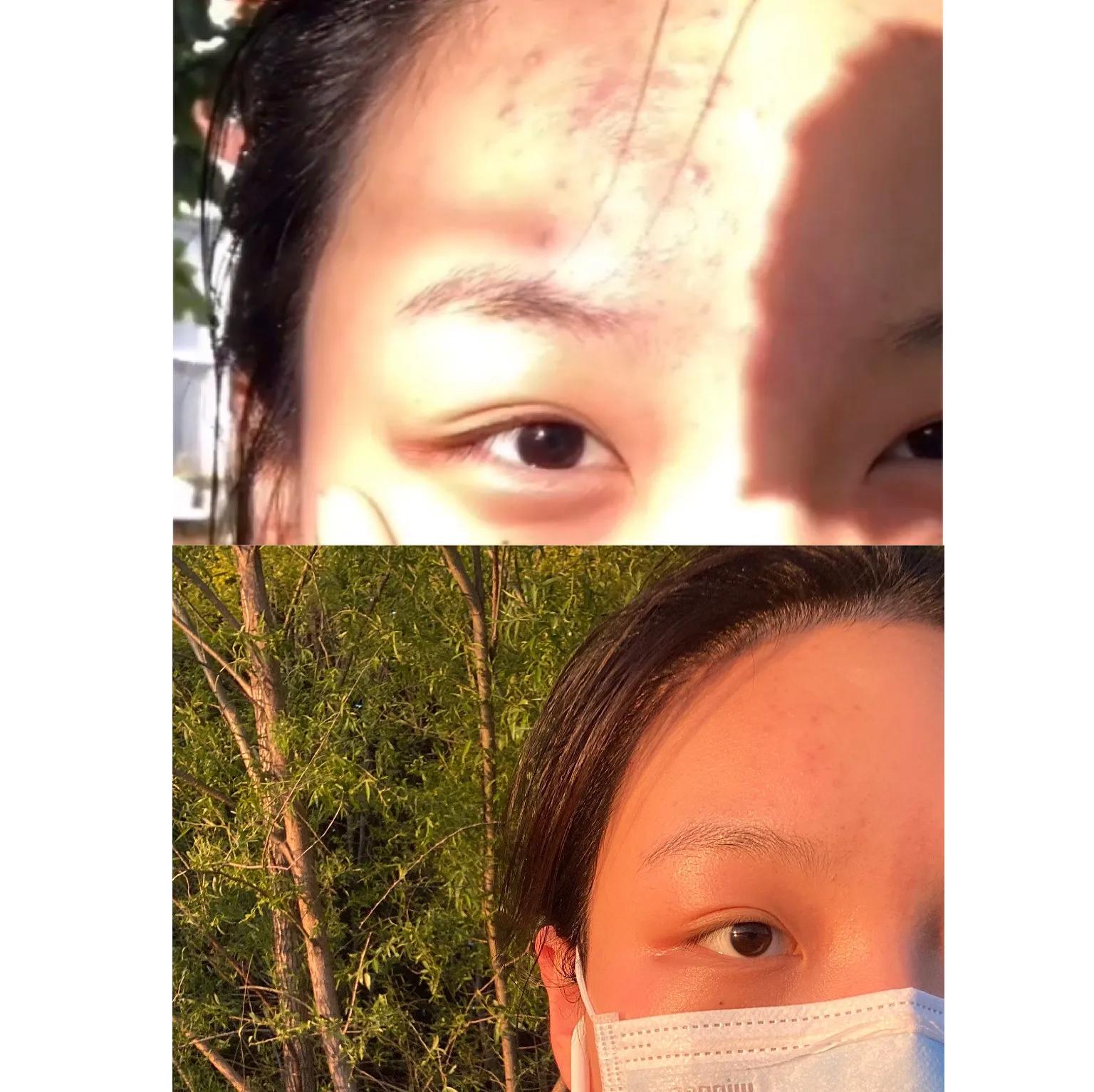 祛痘好物晒单,好物推荐祛痘采访