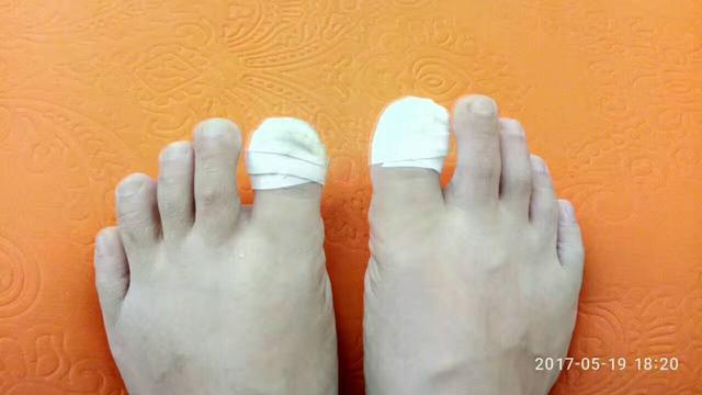 甲沟炎自愈的经历,甲沟炎的亲身经历