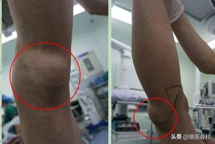 膝盖后面有个鼓鼓的包是不是病,膝盖后面有个包怎么回事