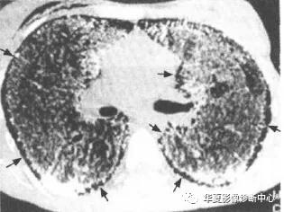 肺部代谢周期是多少天,肺部高代谢病变