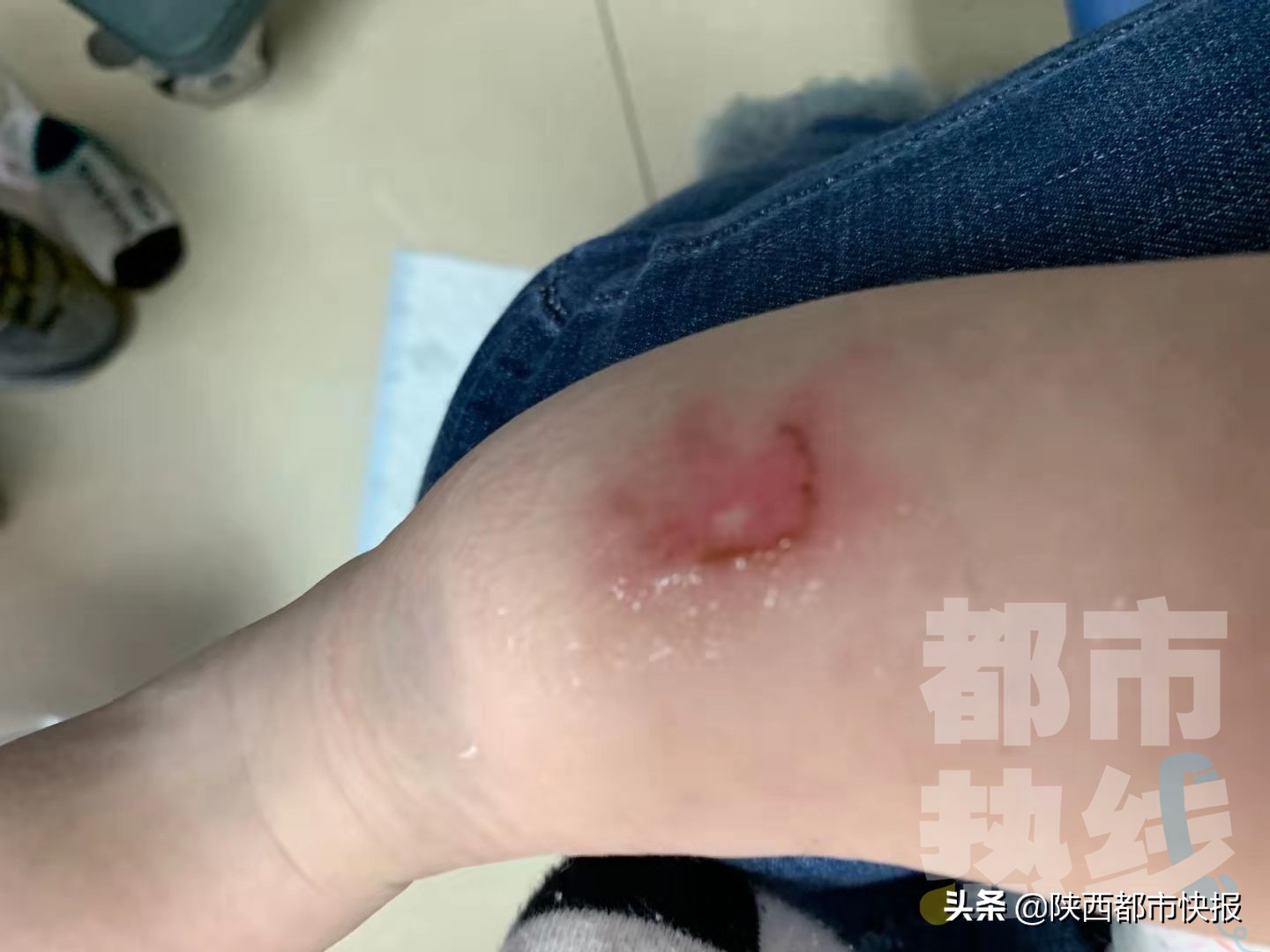 宝宝肚子艾灸烫伤怎么处理,7个月大的孩子发烧推拿