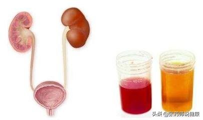 小孩尿尿是红色怎么回事,老人尿尿有血红色是怎么回事