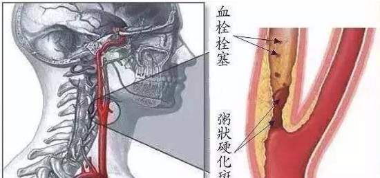 颈部血管有斑块需要怎么处理,颈部血管有斑块可以怎么治疗