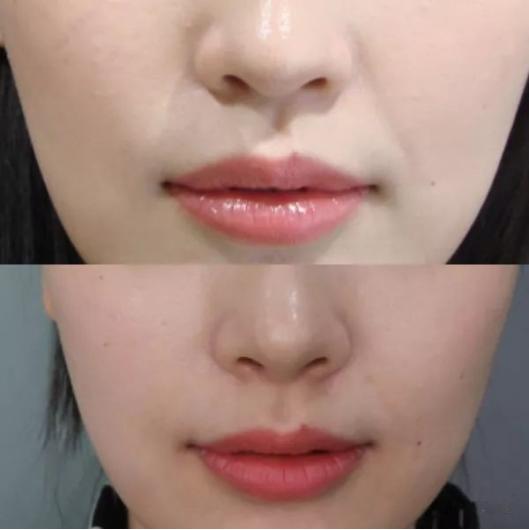 肉毒素和玻尿酸除皱哪个更实惠,如何选择肉毒素和玻尿酸注射除皱