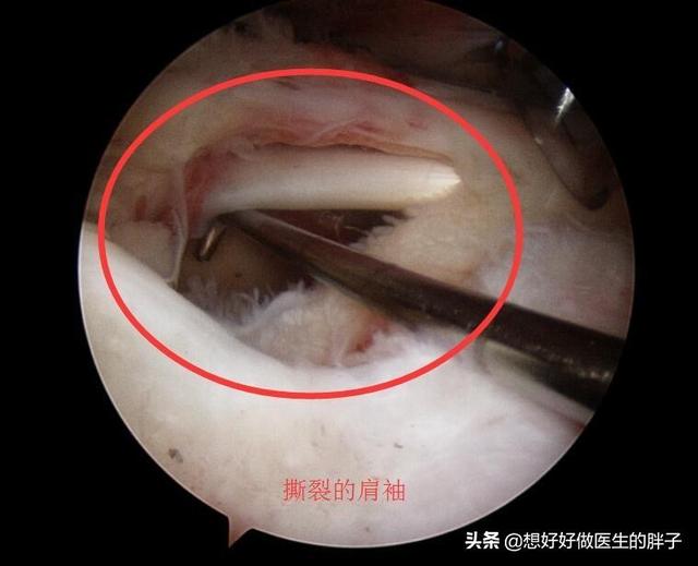 左肩疼痛是什么病的预兆,左肩疼痛要警惕什么病