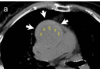 如何监测动脉夹层早期,动脉增强ct能查出主动脉夹层么