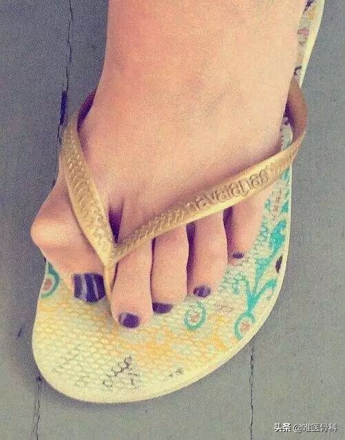 詹姆斯的脚趾发肿,詹姆斯的脚趾是拇外翻吗